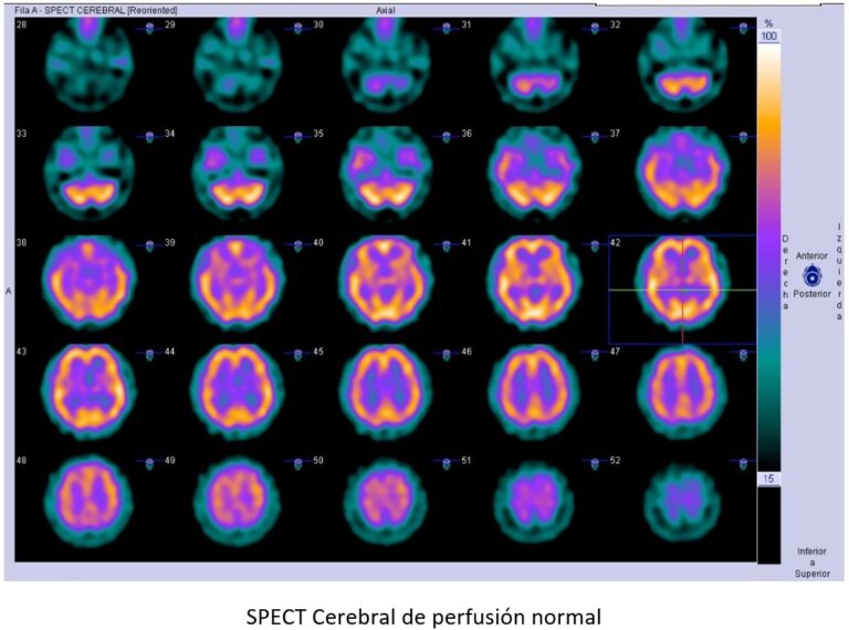 SPECT CEREBRAL DE PERFUSIÓN – Centro Pet Salud